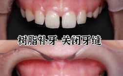 纳米树脂补牙方法效果如何？优势有哪些？