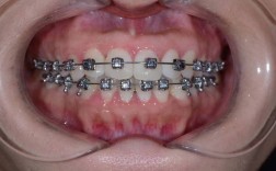 成年正畸能改善偏颌吗？效果及方法有哪些？