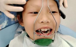 幼儿反颌矫正应在什么年龄段开始？有哪些安全有效的矫正方法适合低龄儿童？家长如何配合治疗？