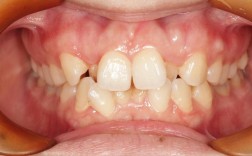 口腔正畸 拥挤度