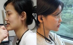 牙齿地包天矫正后