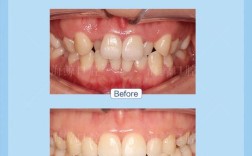 佳木斯矫正牙齿多少钱？效果和医院怎么选？