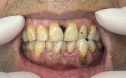 重度牙周炎患者能正畸吗？图片有何警示？