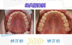 不用牙套矫正牙齿，还有哪些不依赖牙套的可行方法？