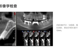 种牙外提升手术感受如何？真实体验与术后恢复过程怎样？