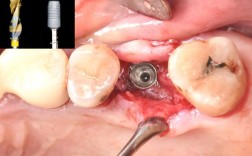 种牙上颌窦提升手术过程到底疼不疼？