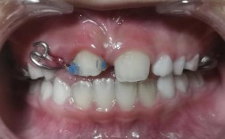 牙齿扭转矫正有哪些常用方法？