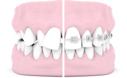 正畸入门要注意什么？新手必看指南有哪些？