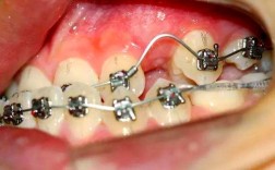 牙齿地包天矫正的地方