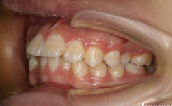 24岁拔牙正畸后为何会出现后遗症？能避免吗？