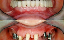 牙槽骨吸收严重到什么程度还能种牙？种牙前需要做哪些骨增量准备？成功率如何？