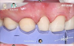 贴面切端预备方法图片