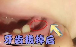 拔牙后种牙，何时种最合适？效果如何？