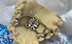 正畸辅弓管扩弓