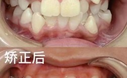 牙齿整形与矫正有何区别？如何选择适合自己的方式？