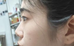 正畸前后侧面对比，脸型变化效果究竟有多大？