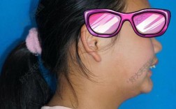 23岁上颌前突正畸