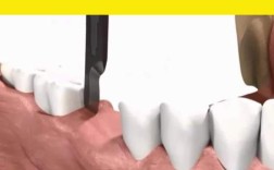 种牙全过程视频