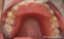 缺两个下颌侧切牙正畸能做吗？效果怎样？