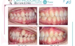 为什么正畸最难移动的就是虎牙？