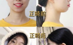 牙齿前突矫正怎么做？效果好吗？有哪些注意事项？要多久？