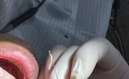 矫正牙齿为何要拔牙神经？