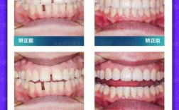 牙齿稀疏能矫正吗？矫正方法有哪些？