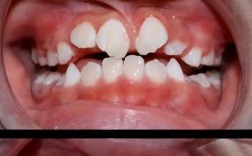 前牙扭转矫正有哪些实用方法？哪种更合适？