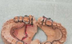 矫正大牙时为何要固定？关键作用与注意事项有哪些？