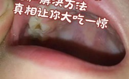 种牙碰到上颌窦说话疼是什么原因？该如何处理？