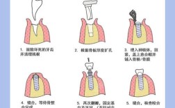 正畸种植钉植入步骤，打钉的关键步骤有哪些？