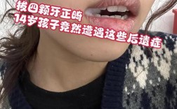 杭州拔牙矫正哪里靠谱？拔牙矫正疼不疼？