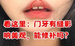 矫正后牙缝变大？是矫正失败还是正常现象？该如何应对？