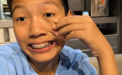 牙齿矫正牙齿掉了，这是怎么回事？