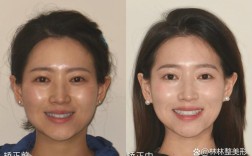 矫正牙齿前后图片，变化为何如此惊人？