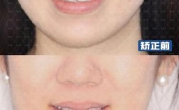 牙齿矫正后脸颊凹陷正常吗？图片解析原因与改善方法