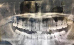 智齿位置如何助力矫正牙齿？方法可行吗？