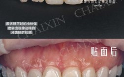 牙齿矫正会引发牙齿脱矿吗？