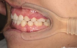 口腔正畸下颌骨紊乱