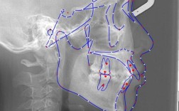 正畸头颅侧位定点软件如何通过精准定位提升错颌畸形诊断效率与方案个性化？
