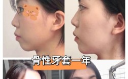 牙齿矫正前后侧面对比照片，能直观看出哪些面部改善？