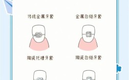 自锁矫正牙齿的原理是什么？如何实现牙齿移动？