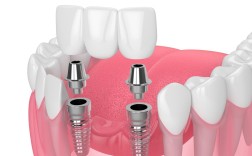 昆山牙博士种牙效果如何？技术、服务、价格真实评价怎么样？