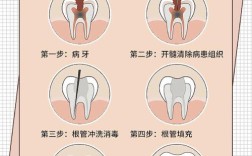 根管治疗寻找根管口方法