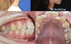 拔牙矫正牙齿前后图片