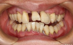 种牙二期后后牙松动是什么原因导致的？需要立即处理吗？会不会影响种植牙的长期使用寿命？