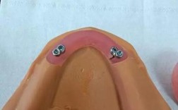 数字化种植义齿制作方法的核心流程、技术要点及质量控制是什么？