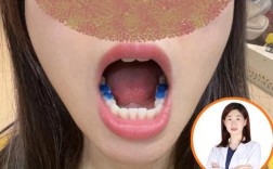 磨牙都坏了怎么做正畸