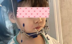 地包天牙齿矫正图片