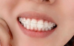 陶瓷半隐形矫正，隐形效果与舒适度到底如何？